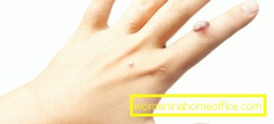 Брадавици по пръста: причини